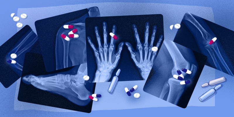 Помогут ли хондропротекторы восстановить хрящ